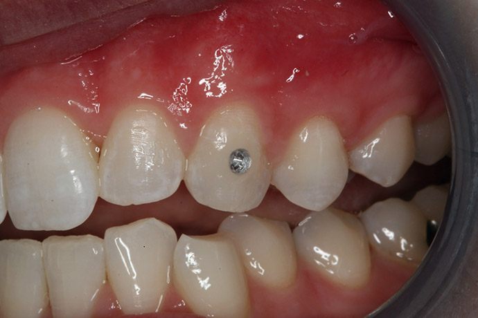 Quick easy restorations