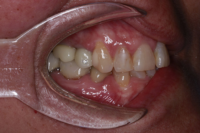 See Why Patients Choose Us for Premium Crowns